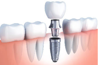 Dental Implants