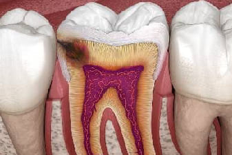 assets/services/root-canal-treatment.jpg